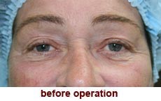 plastic-surgery-blepharoplasty