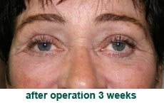 plastic-surgery-blepharoplasty