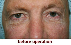 plastic-surgery-blepharoplasty