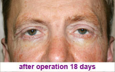 plastic-surgery-blepharoplasty