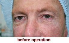 plastic-surgery-blepharoplasty