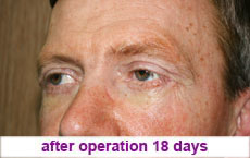 plastic-surgery-blepharoplasty