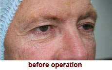 plastic-surgery-blepharoplasty