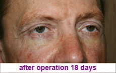 plastic-surgery-blepharoplasty