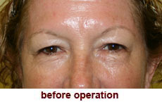 plastic-surgery-blepharoplasty