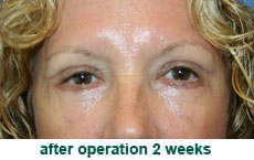 plastic-surgery-blepharoplasty