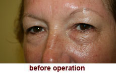 plastic-surgery-blepharoplasty