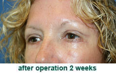 plastic-surgery-blepharoplasty