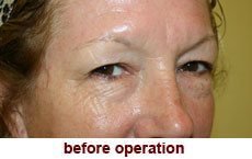 plastic-surgery-blepharoplasty