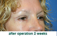 plastic-surgery-blepharoplasty