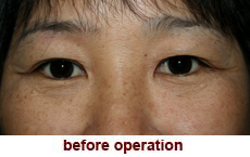 plastic-surgery-blepharoplasty