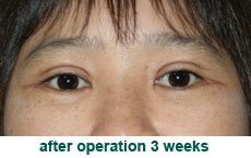 plastic-surgery-blepharoplasty