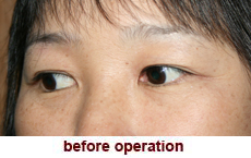 plastic-surgery-blepharoplasty