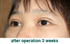 plastic-surgery-blepharoplasty