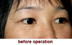 plastic-surgery-blepharoplasty