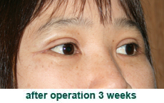 plastic-surgery-blepharoplasty