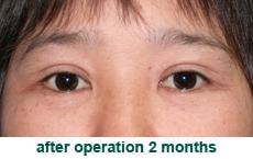 plastic-surgery-blepharoplasty