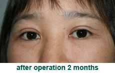 plastic-surgery-blepharoplasty