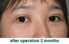 plastic-surgery-blepharoplasty