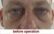 plastic-surgery-blepharoplasty