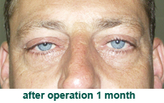 plastic-surgery-blepharoplasty