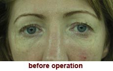 plastic-surgery-blepharoplasty