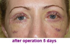 plastic-surgery-blepharoplasty