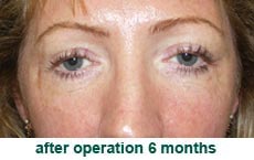 plastic-surgery-blepharoplasty