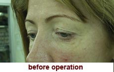 plastic-surgery-blepharoplasty