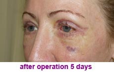 plastic-surgery-blepharoplasty