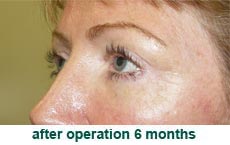 plastic-surgery-blepharoplasty