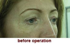 plastic-surgery-blepharoplasty