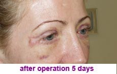 plastic-surgery-blepharoplasty