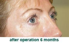 plastic-surgery-blepharoplasty