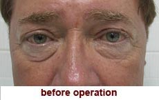 plastic-surgery-blepharoplasty