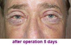 plastic-surgery-blepharoplasty