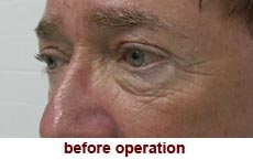 plastic-surgery-blepharoplasty