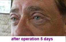 plastic-surgery-blepharoplasty