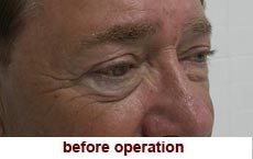 plastic-surgery-blepharoplasty