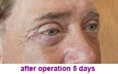 plastic-surgery-blepharoplasty