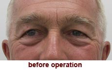 plastic-surgery-blepharoplasty