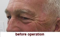 plastic-surgery-blepharoplasty