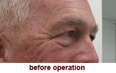 plastic-surgery-blepharoplasty