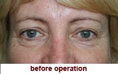 plastic-surgery-blepharoplasty