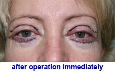 plastic-surgery-blepharoplasty