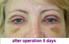 plastic-surgery-blepharoplasty