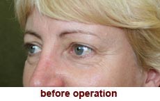 plastic-surgery-blepharoplasty