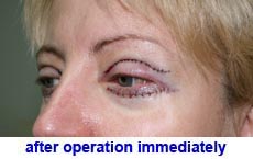 plastic-surgery-blepharoplasty