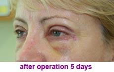 plastic-surgery-blepharoplasty