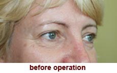 plastic-surgery-blepharoplasty